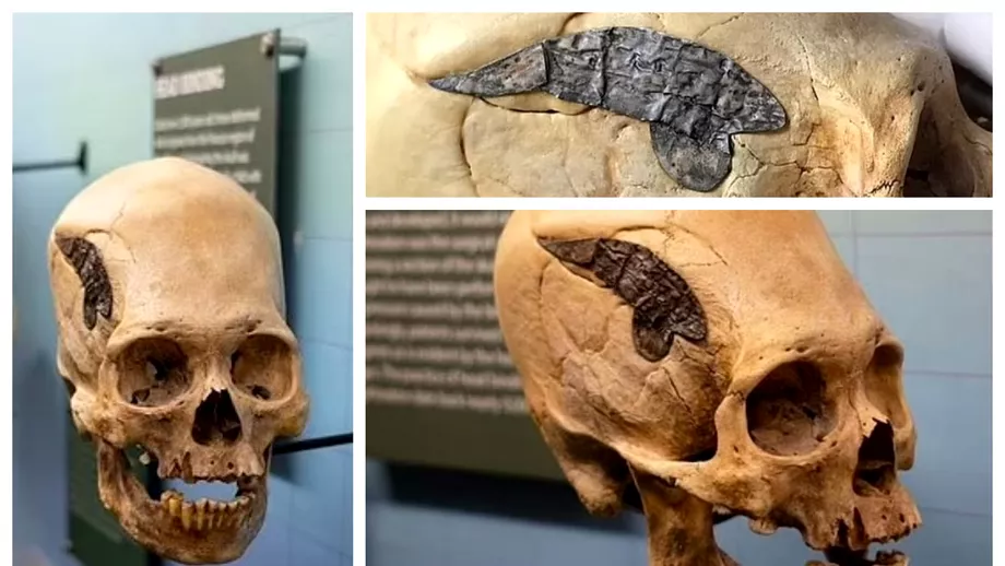 Prima interventie chirurgicala asupra unui craniu are 2000 de ani O placuta metalica folosita pentru a repara o fractura