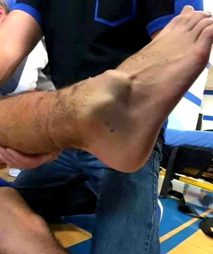 Prima imagine cu piciorul lui Andre Gomes
