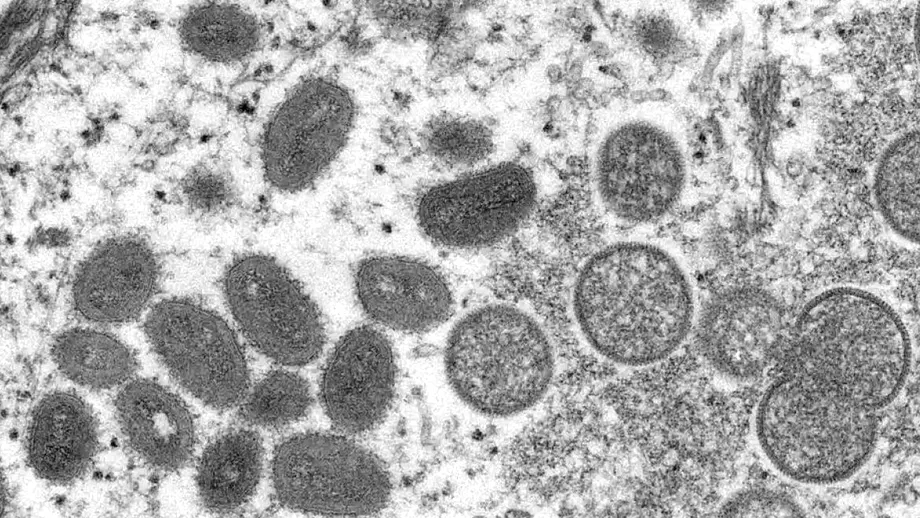 Virusul variolei maimutei sufera mutatii neobisnuite avertizeaza specialistii Exista temeri ca sar putea raspandi in moduri atipice