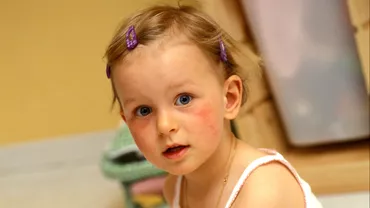 Dermatita atopica la copii cum o tinem sub control Solutii pentru o piele sanatoasa