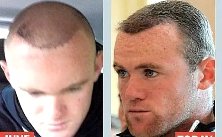 Wayne-Rooney-Hair-Transplant4