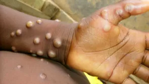 Ce se intampla in Romania cu variola maimutei Anunt important al unui specialist in boli infectioase