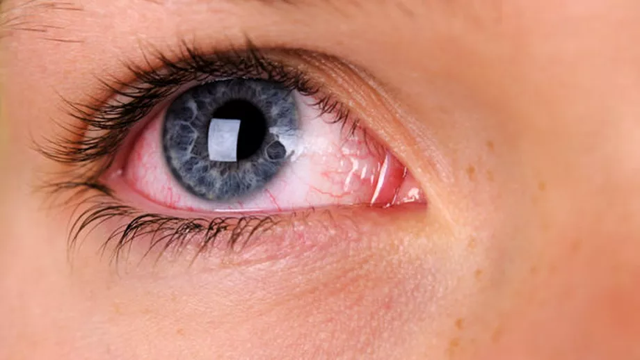 Ochii rosii ar putea fi simptom de coronavirus Descoperirea cercetatorilor americani