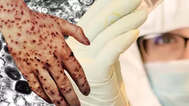 Inca trei cazuri de variola maimutei in Romania Anchete epidemiologice demarate de urgenta
