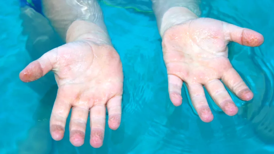 De ce se increteste pielea de pe palme si talpi in apa Ce informatii ofera fenomenul despre starea noastra de sanatate