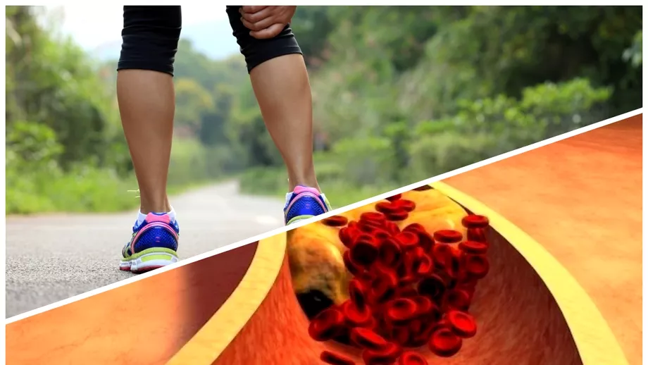 Primul simptom care iti spune ca ai colesterolul ridicat Ce se intampla cu picioarele tale