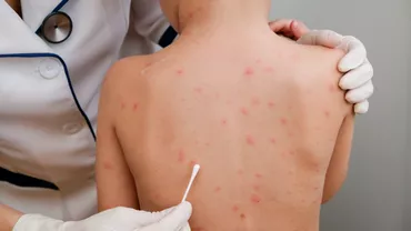 Un nou virus contagios se raspandeste printre copii Ce este gripa tomatelor si cum se manifesta