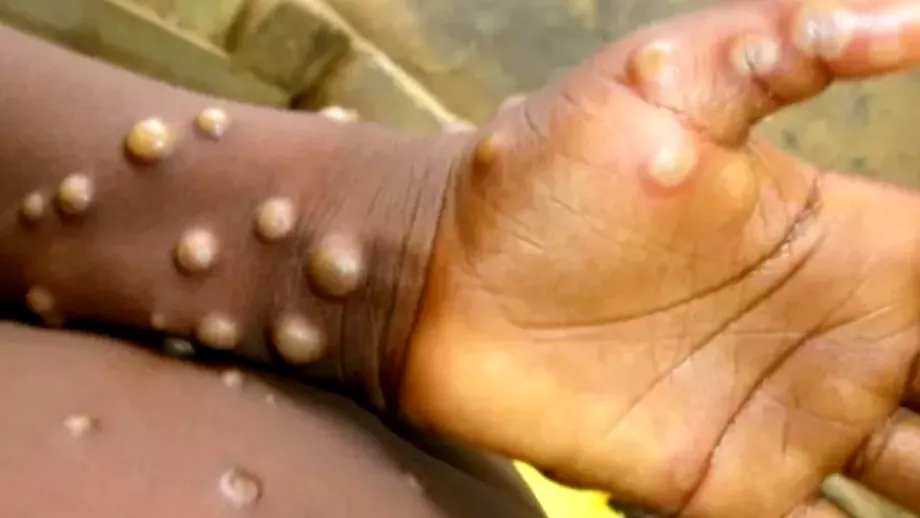 Inca un caz de variola maimutei in Romania Cine este al saselea roman infectat