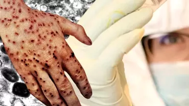OMS anunta doua noi decese cauzate de variola maimutei Numarul total al mortilor se apropie de 80